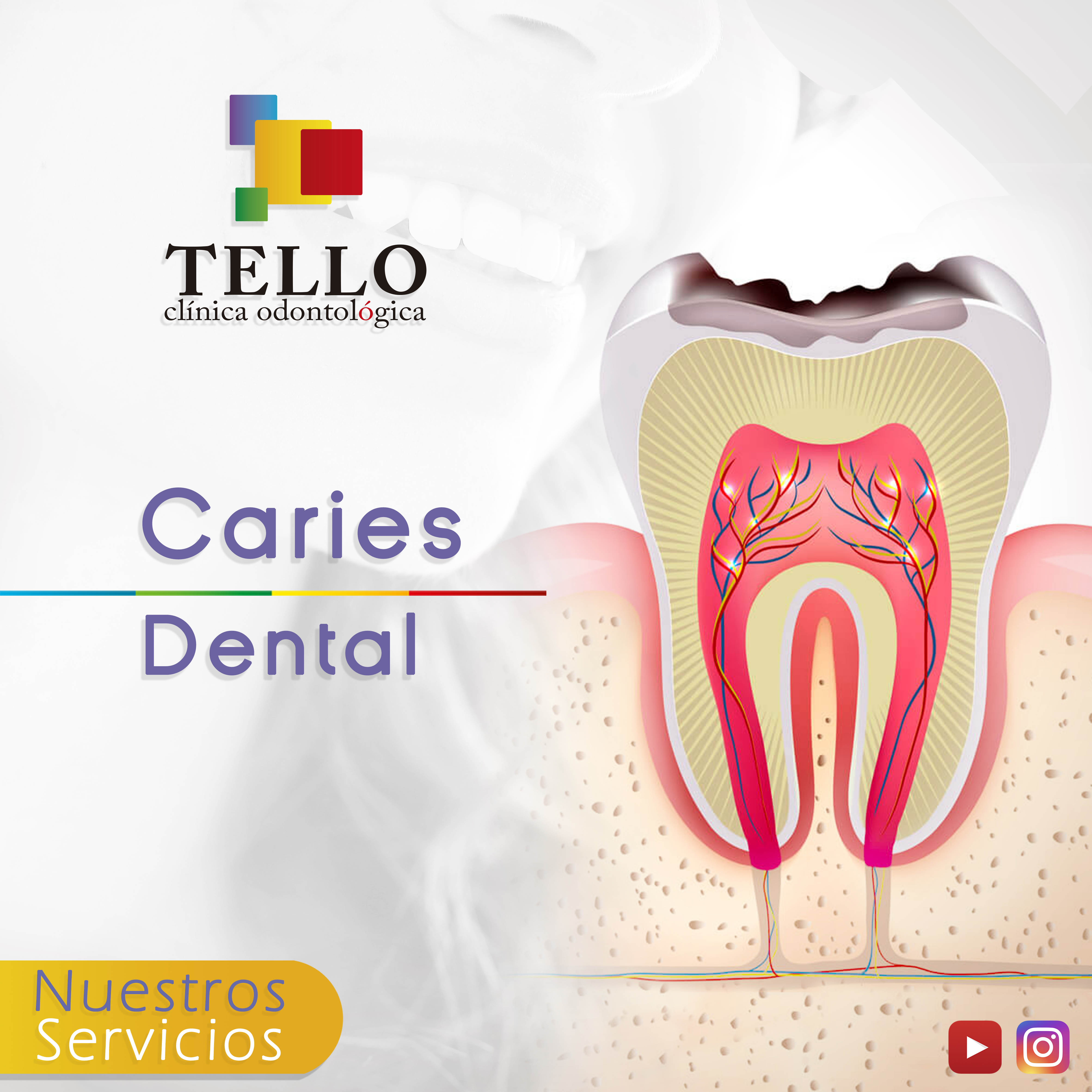 Caries dental Tello Odontología