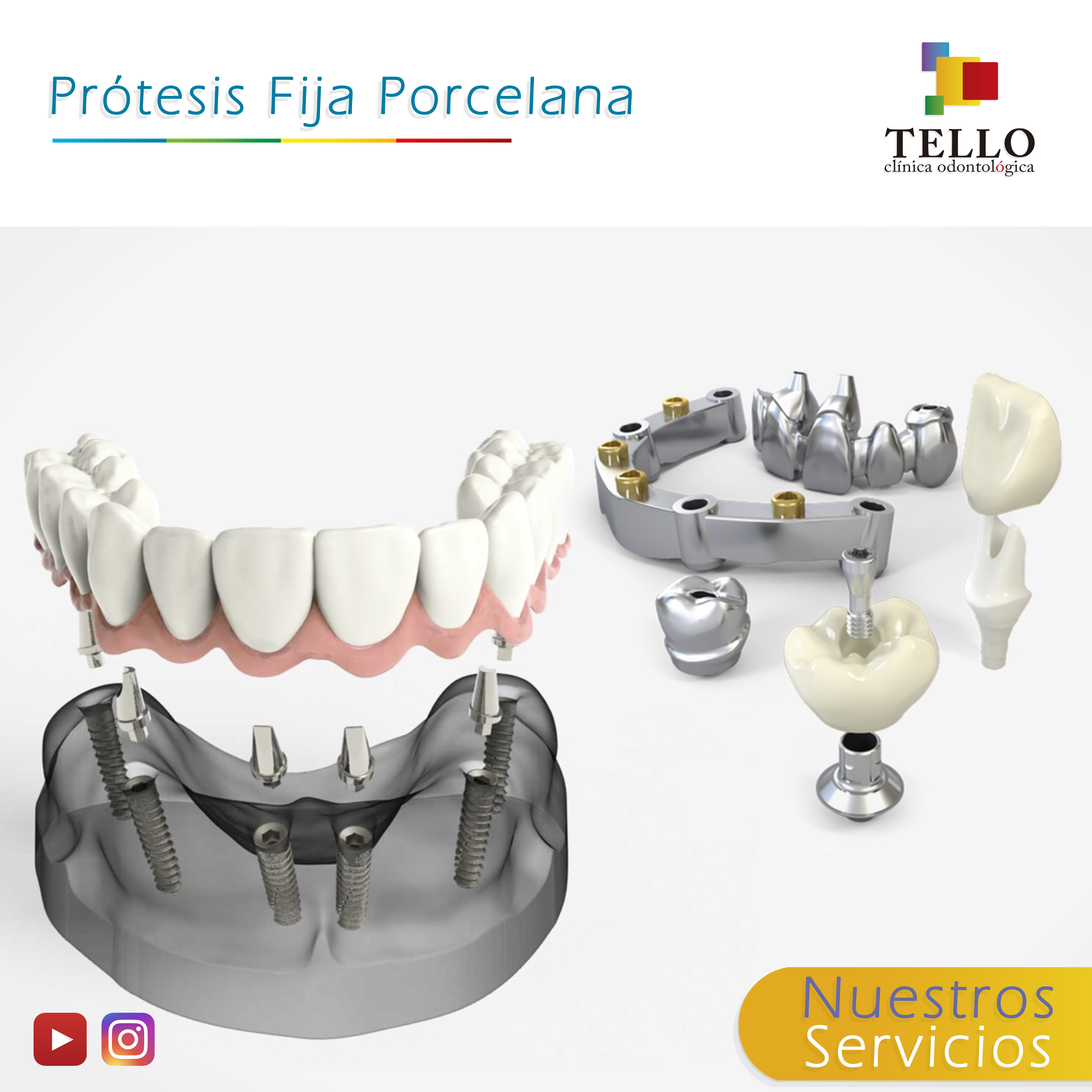 Porótesis Fija porcelana Tello Odontología Cochabamba